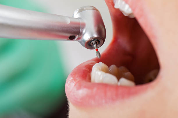 Best Chipped Tooth Repair Near Me  in Clarendon, TX
